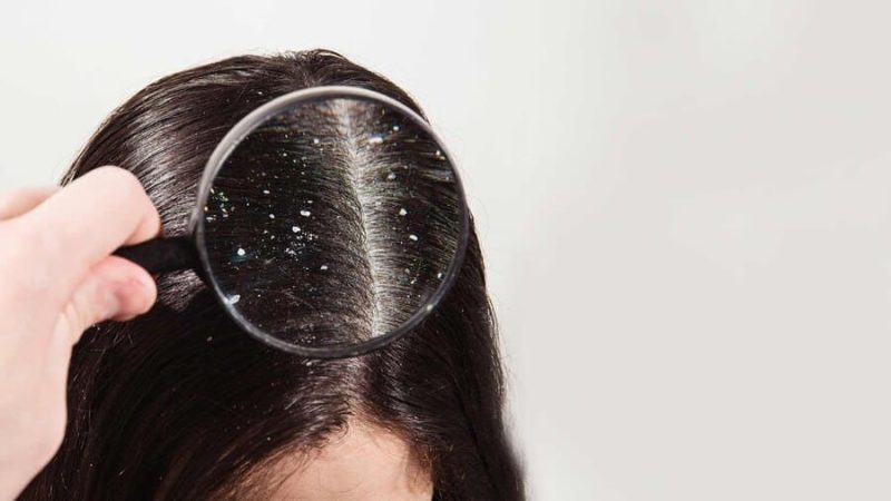 как победить перхоть