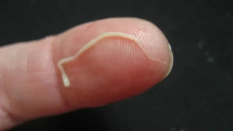 паразит под кожей