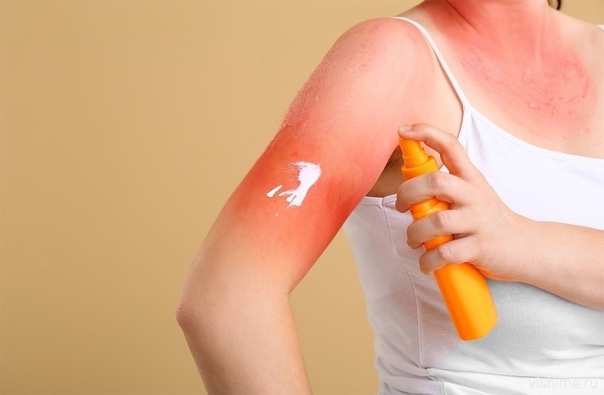 Солнечная аллергия в Турции - массовые случаи