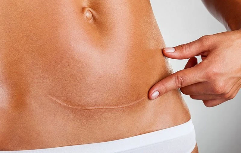 Шрам от кесарево сечения