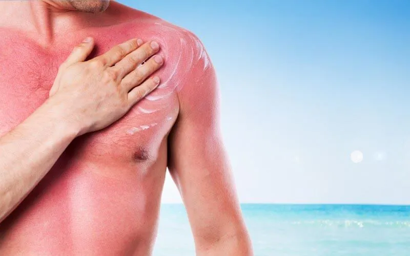 Помощь при ожоге