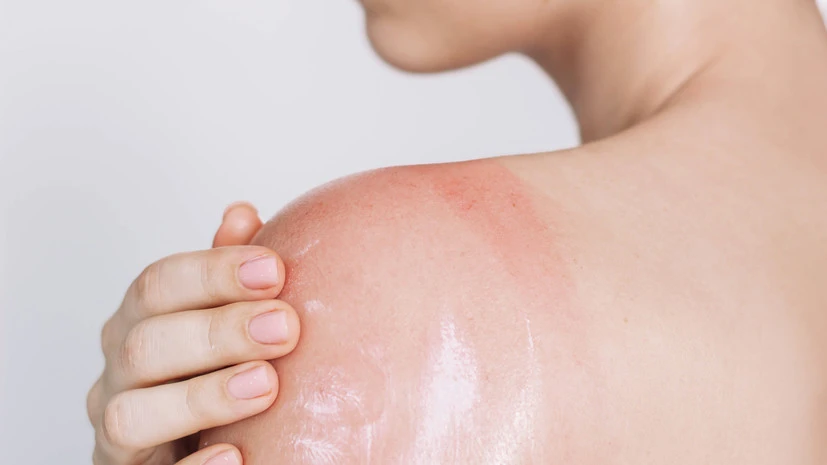 Помощь при ожоге