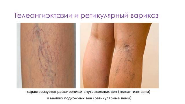 Ретикулярный варикоз и телеангиоэктазии