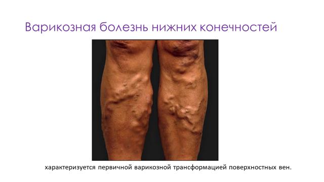 Варикоз