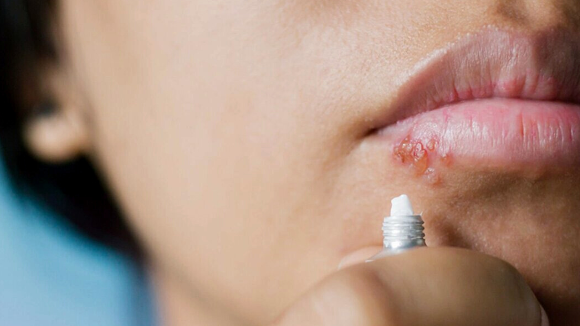 Герпес на губах