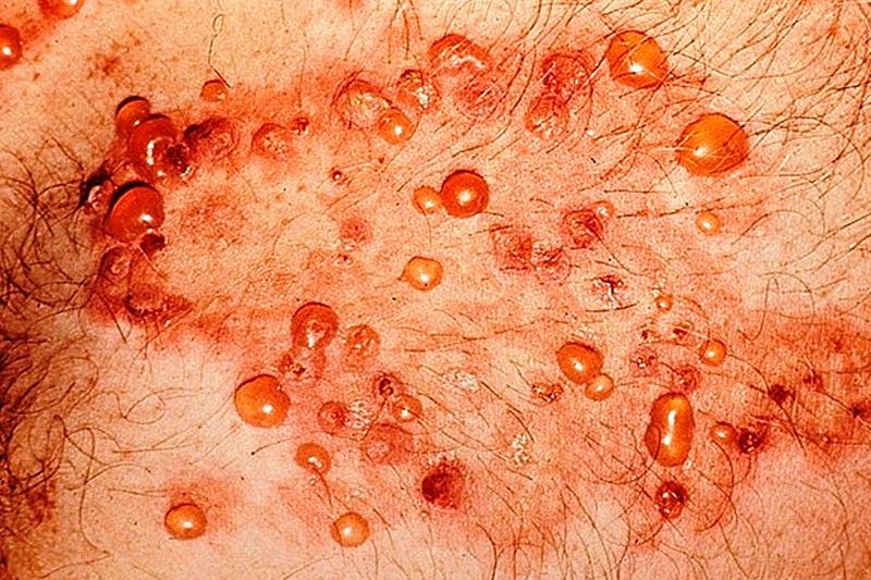 Пузырчатка