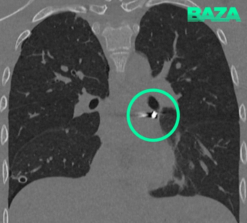 Рентген легких